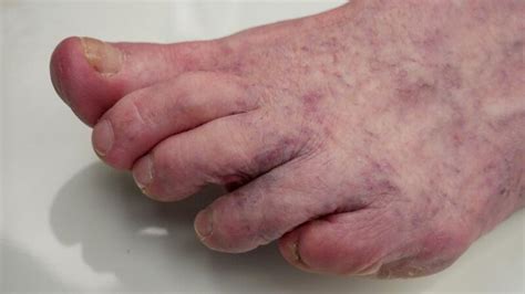 It may also occur due to extreme cold, affecting your legs, arms or even face. . Pictures of mottled feet before death